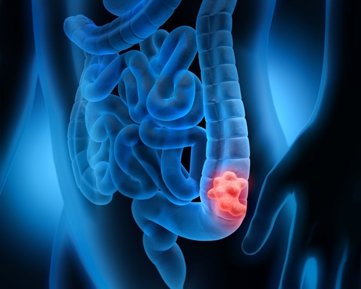 Terapia aprobada para otro cáncer podría mejorar tratamiento del colorrectal avanzado