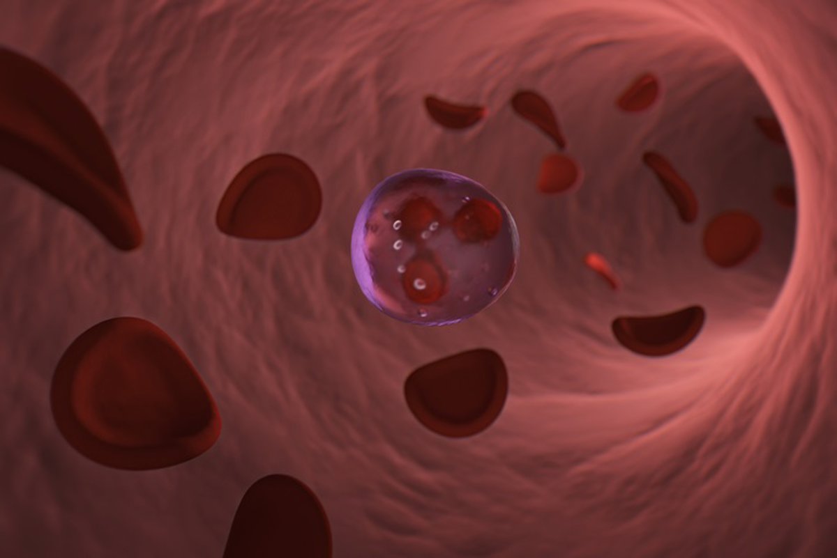 Terapia experimental muestra resultados prometedores contra leucemia difícil