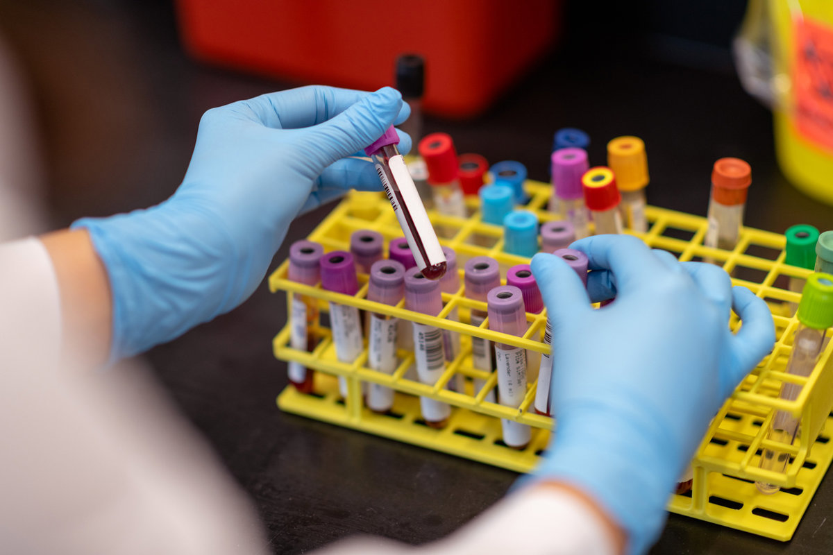 IA mejora biopsia líquida para detección temprana de cáncer de hígado