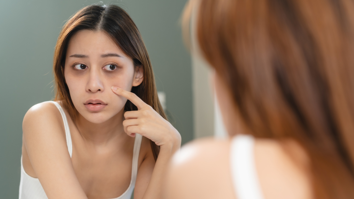 Ojeras y fatiga: señales de deficiencia de hierro