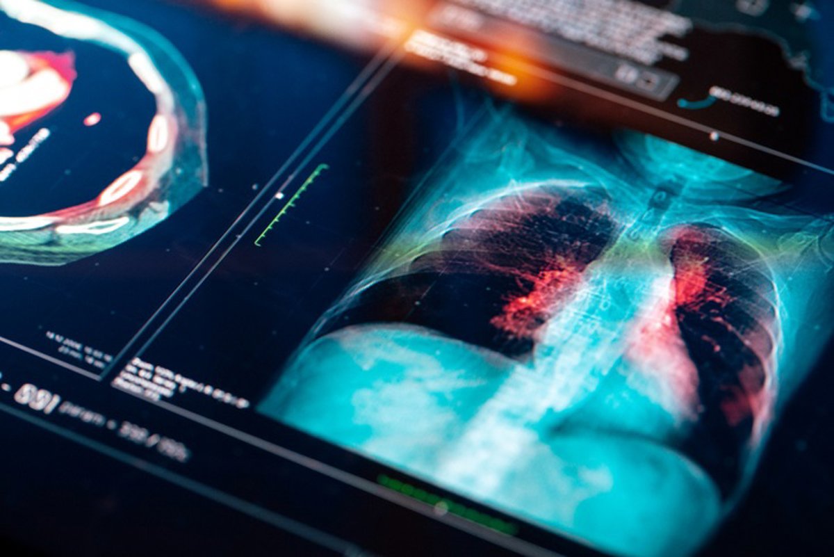 Mutación hereditaria del gen EGFR aumenta riesgo de cáncer