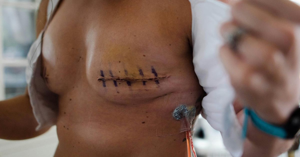 Mujeres de 45 a 74 años podrán acceder gradualmente a cribado de cáncer de mama