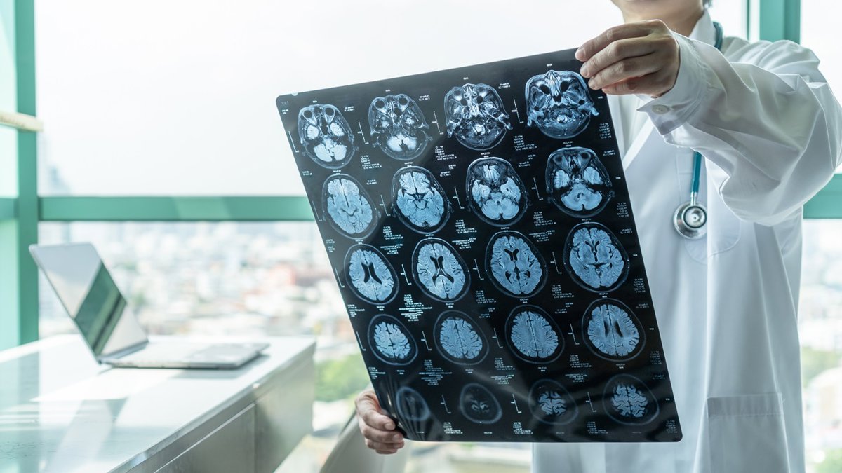 Fármaco contra tumores cerebrales reduce lesiones en cavernomas en ratones